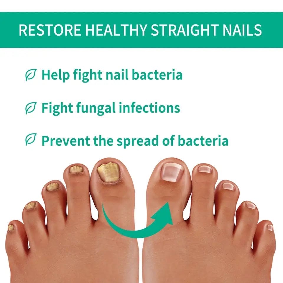 Nail Fungus Solution, Anti Infection Nail Fungus Removal Gel, Ingrown Toenail Treatment Nail Care Oil, Nail Fungus Treatments Serum Nail Fungus Solution, Anti Infection Nail Fungus Removal Gel, Ingrown Toenail Treatment Nail Care Oil, Nail Fungus Treatments Serum